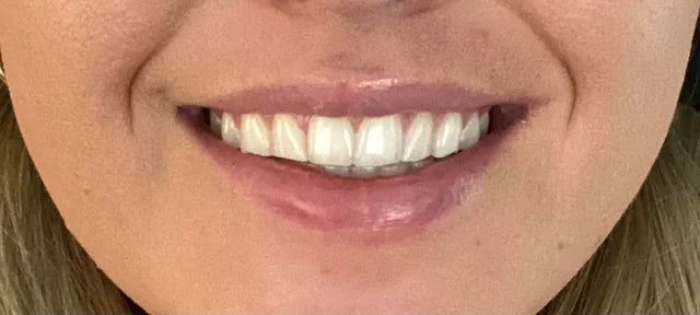 My Teeth Are Still Getting Damaged Despite Using Store-Bought Guards
